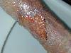 Ulcera mista (800Wx600H) - Ulcera mista arterovenosa. Cortesia di Emilio Sani, dermatologo a Collecchio (PR).<br> Per concessione di www.listaippocrate.it: atlante dermatologico 