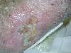 Ulcera venosa (800Wx600H) - Ulcera venosa con lipodermatosclerosi. Cortesia di Emilio Sani, <br> dermatologo a Collecchio (PR). Per concessione di www.listaippocrate.it: atlante dermatologico 
